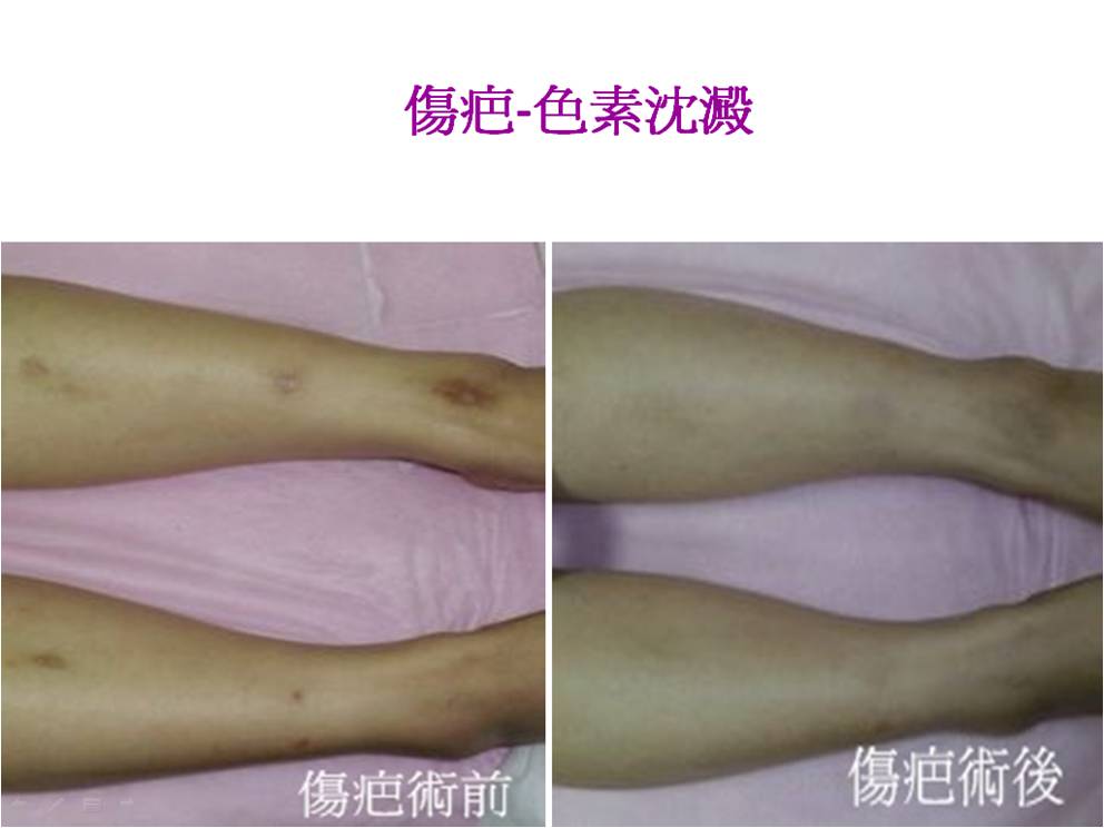 傷疤-色素沉澱