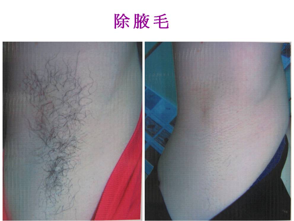 除腋毛