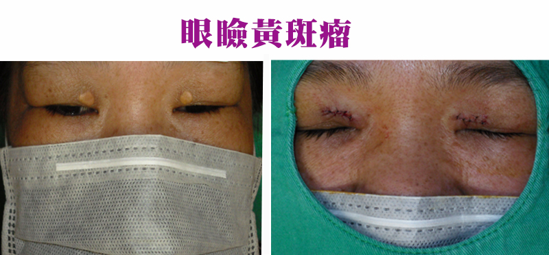 眼瞼黃斑瘤手術