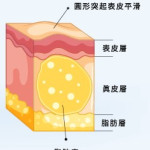 脂肪瘤