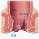 新莊外科-痔瘡手術